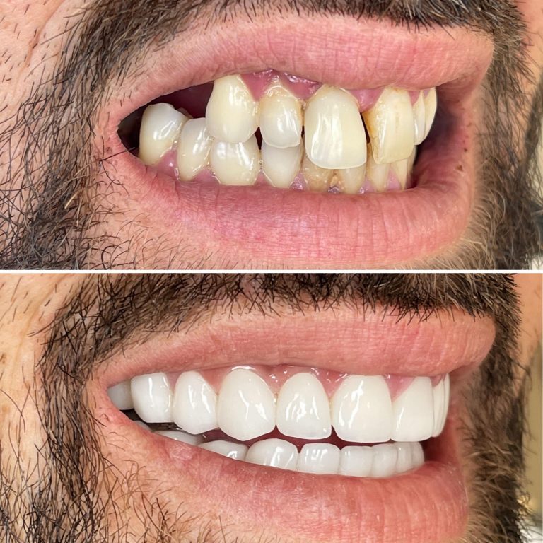 IPS EMAX Veneers/ Crowns Dent MEX